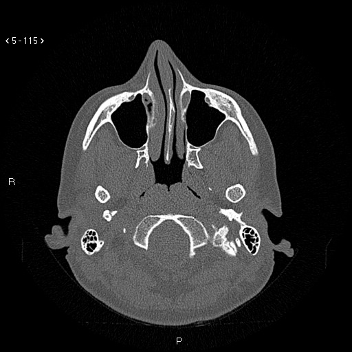 Nasolabial cyst (Radiopaedia 75125-86194 Axial bone window 76).jpg