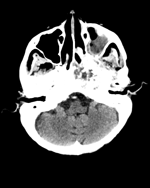 Nasopharyngeal carcinoma with cerebral abscess (Radiopaedia 43018-46275 Axial C+ delayed 12).png