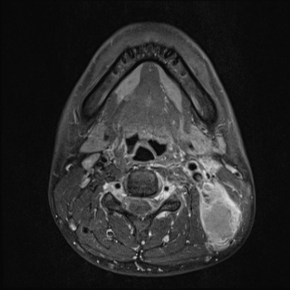 Nasopharyngeal carcinoma with skull base invasion (Radiopaedia 53415-59485 Axial T1 C+ fat sat 47).jpg