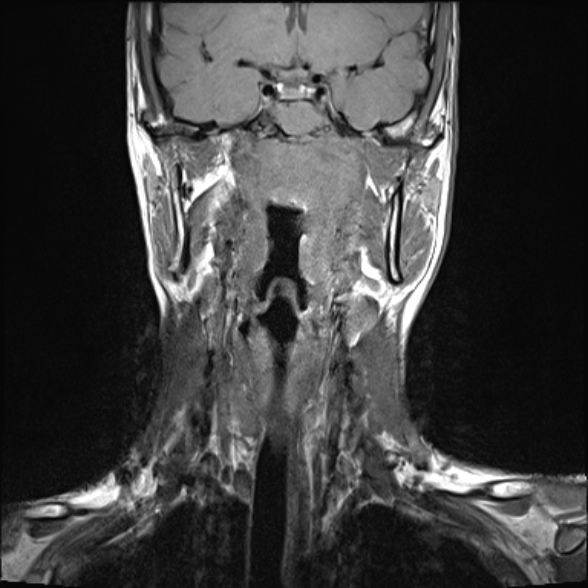 Nasopharyngeal carcinoma with skull base invasion (Radiopaedia 53415-59485 Coronal T1 20).jpg