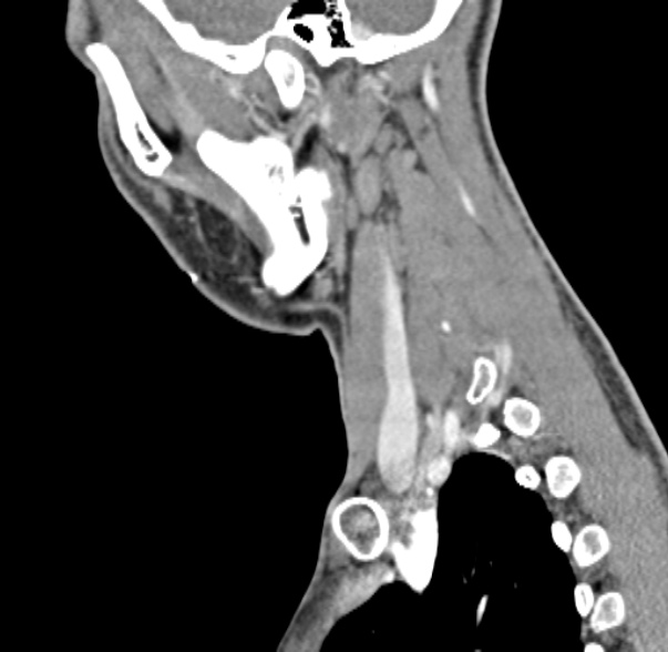 Nasopharyngeal carcinoma with skull base invasion (Radiopaedia 53415-59705 C 15).jpg