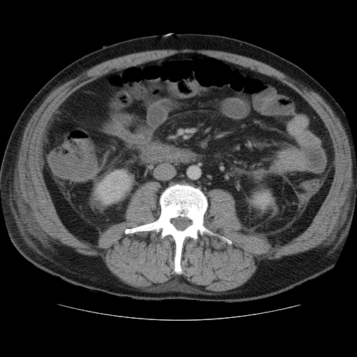 File:Necrotizing pancreatitis - acute necrotic collection maturing into walled-off pancreatic necrosis (Radiopaedia 9602-10249 A 11).jpg
