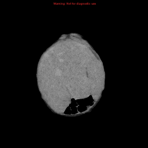 File:Neonatal neuroblastoma (Radiopaedia 9564-10223 B 20).jpg