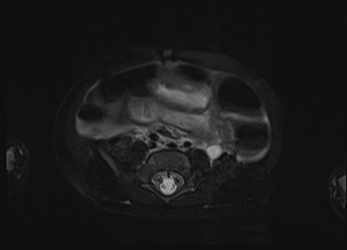 Neonatal prostatic utricle abscess - cyst (Radiopaedia 69511-79394 Axial T2 fat sat 36).jpg