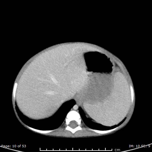 File:Nephroblastomatosis (Radiopaedia 41934-44935 A 10).jpg
