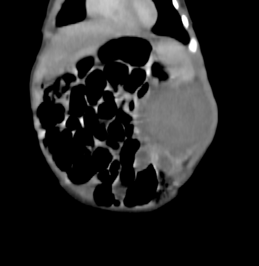 Nephroblastomatosis (Radiopaedia 71294-81607 B 85).jpg