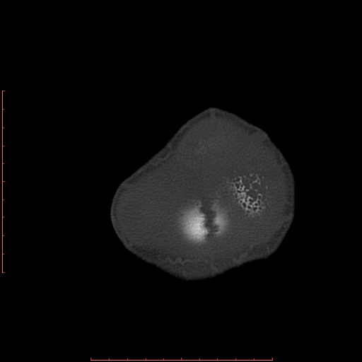 File:Neuroblastoma skull metastasis (Radiopaedia 56053-62683 Axial bone window 26).jpg