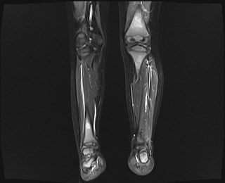 File:Neuroblastoma with bone metastases (Radiopaedia 67080-76414 B 9).jpg