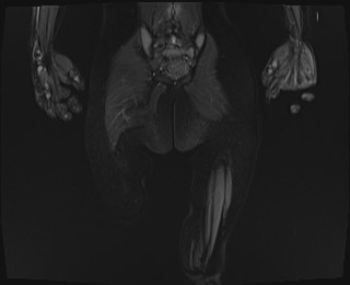 File:Neuroblastoma with bone metastases (Radiopaedia 67080-76414 Coronal STIR 22).jpg