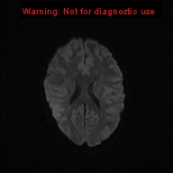 File:Neurofibromatosis type 1 with optic nerve glioma (Radiopaedia 16288-15965 Axial DWI 57).jpg