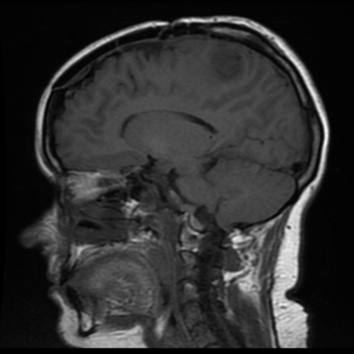 File:Neurofibromatosis type 2 (Radiopaedia 45229-49247 Sagittal T1 12).png
