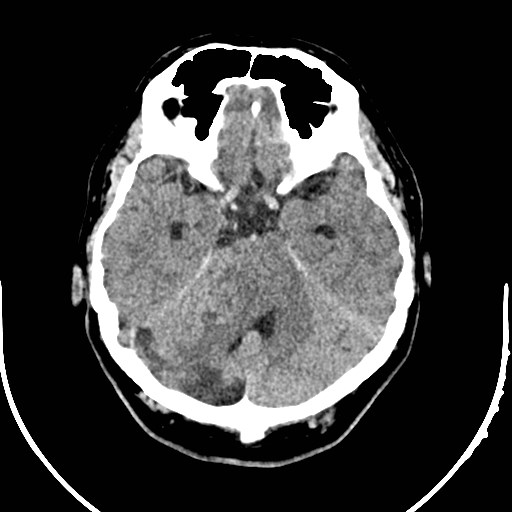Neurofibromatosis type 2 (Radiopaedia 79097-92047 Axial non-contrast 19).jpg
