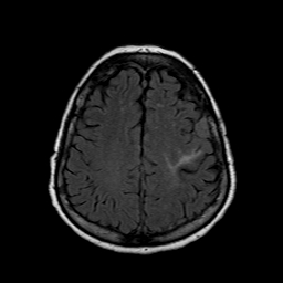 File:Neurofibromatosis type 2 (Radiopaedia 8713-9518 Axial FLAIR 7).jpg
