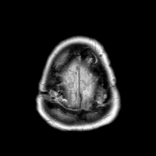 File:Neurofibromatosis type 2 (Radiopaedia 8713-9518 Axial Gradient Echo 2).jpg