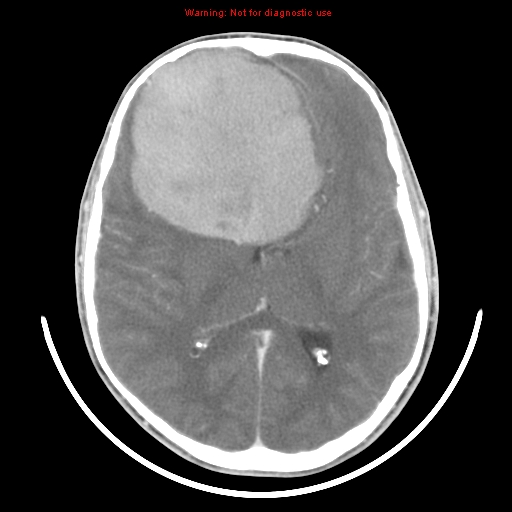 File:Neurofibromatosis type 2 (Radiopaedia 8953-9732 C 19).jpg