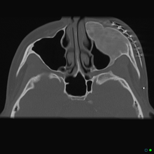 File:Neurostimulators for facial pain- underlying fibrous dysplasia (Radiopaedia 27549-27754 Oblique bone window 1).jpg