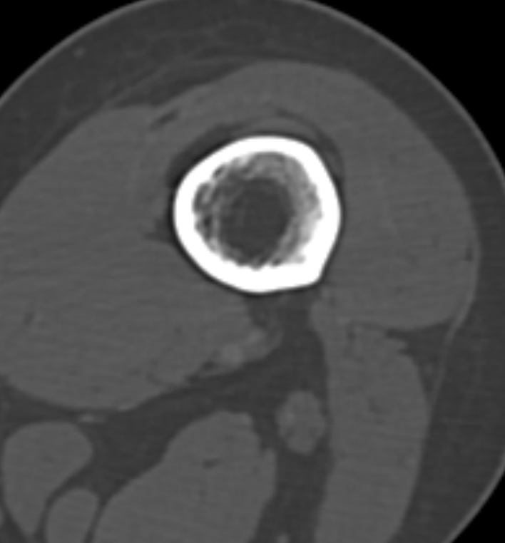 Non-ossifying fibroma - femur (Radiopaedia 82786-97042 Axial bone window 33).jpg