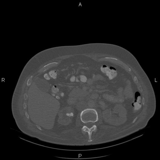 Non Hodgkin lymphoma in a patient with ankylosing spondylitis (Radiopaedia 84323-99624 Axial bone window 36).jpg