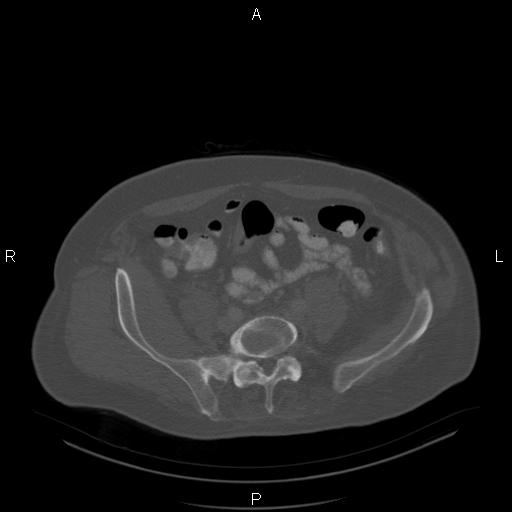 Non Hodgkin lymphoma in a patient with ankylosing spondylitis (Radiopaedia 84323-99624 Axial bone window 51).jpg