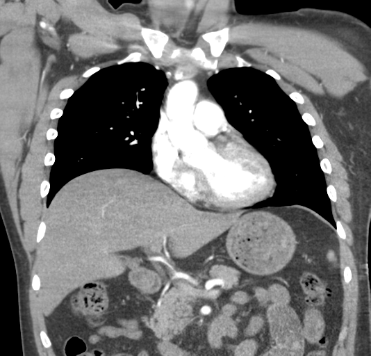 File:Normal CTA thorax (non ECG gated) (Radiopaedia 41750-44704 B 39).png