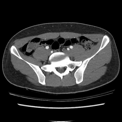 File:Normal CT angiogram of pelvis (Radiopaedia 45390-49430 A 26).jpg