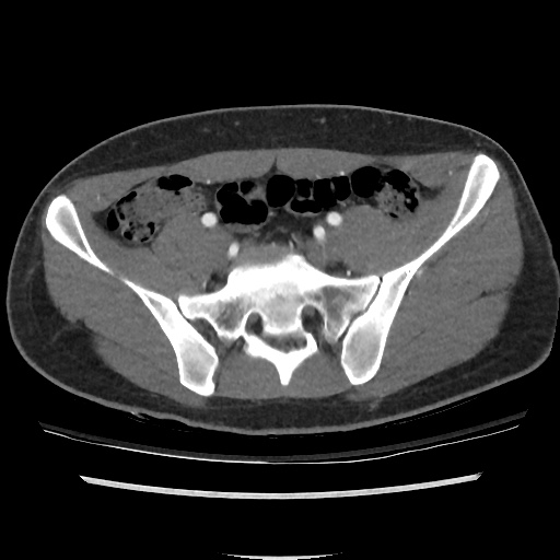 File:Normal CT angiogram of pelvis (Radiopaedia 45390-49430 A 28).jpg