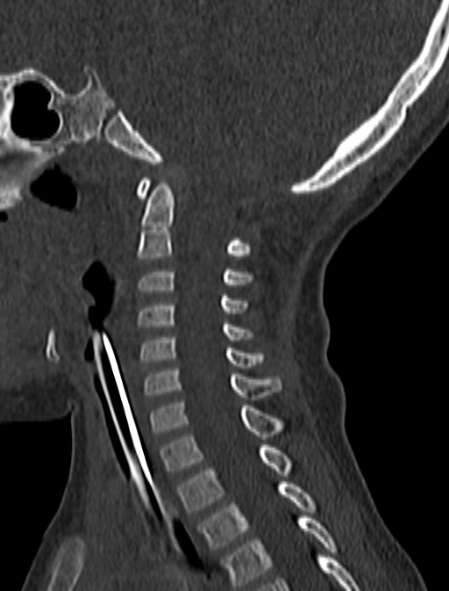 File:Normal CT cervical spine - pediatric (Radiopaedia 52549-58462 Sagittal bone window 110).jpg