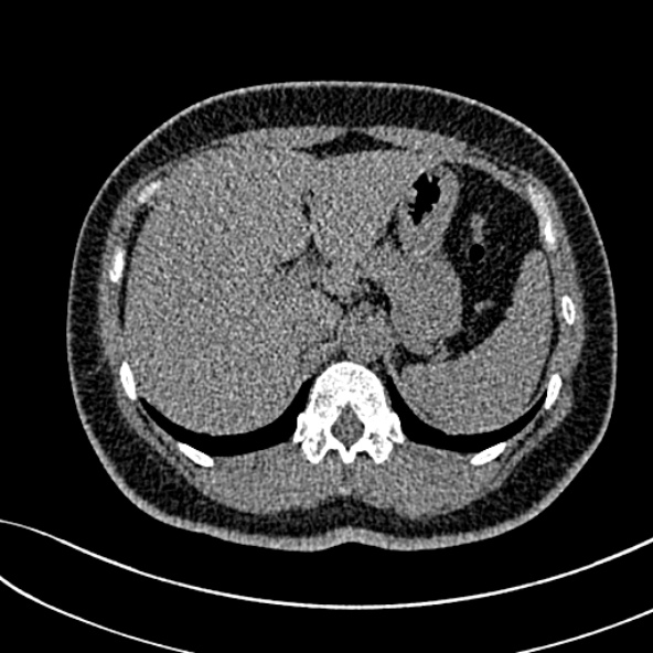 Normal CT chest- adult female (Radiopaedia 52522-58428 Axial non-contrast 126).jpg