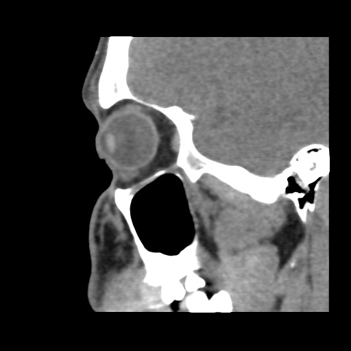 Normal CT paranasal sinuses (Radiopaedia 42286-45390 F 109).jpg