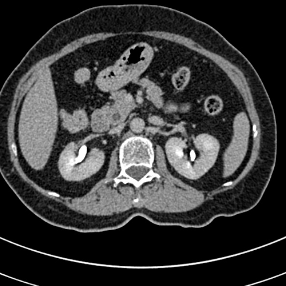 File:Normal CT split bolus study of the renal tract (Radiopaedia 48631-53634 Axial split bolus 61).jpg