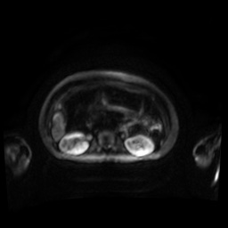 Normal MRI abdomen in pregnancy (Radiopaedia 88001-104541 Axial DWI 76).jpg