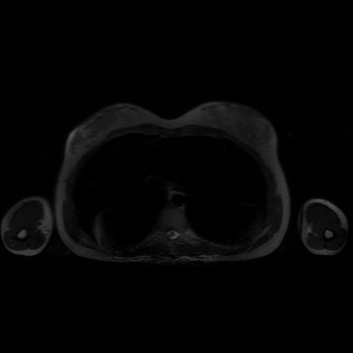 File:Normal MRI abdomen in pregnancy (Radiopaedia 88001-104541 Axial T2 1).jpg