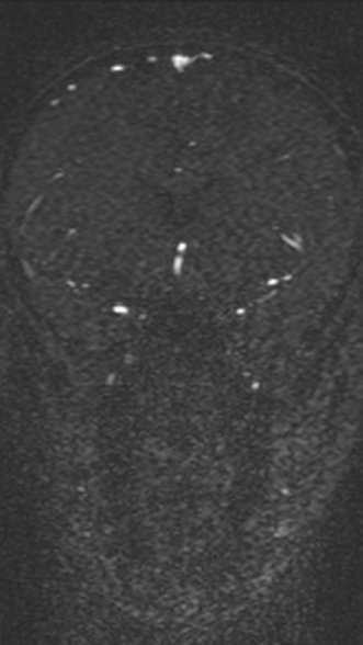 Normal MRI brain with MRV- teenager (Radiopaedia 49425-54553 Coronal MRV 100).jpg