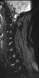 File:Normal MRI cervical spine (infection protocol) (Radiopaedia 53916-60039 Sagittal DWI 10).png