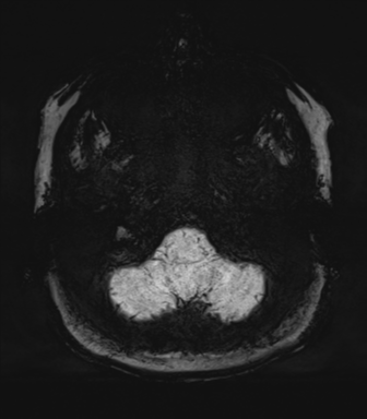 Normal MRI internal auditory canal (Radiopaedia 41613-44525 Axial SWI MIP 8).png