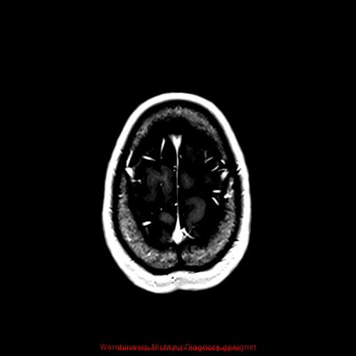 Normal adult brain MRI (non-enhanced and contrast-enhanced) (Radiopaedia 75262-86379 Axial T1 C+ 163).jpg