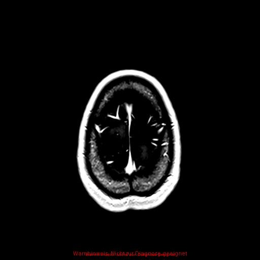 Normal adult brain MRI (non-enhanced and contrast-enhanced) (Radiopaedia 75262-86379 Axial T1 C+ 165).jpg