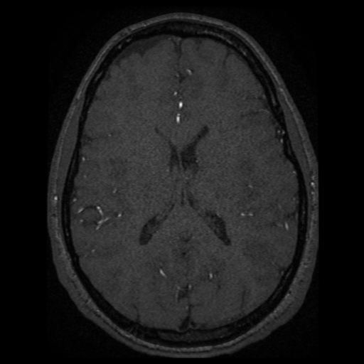 Normal brain MRA (Radiopaedia 41046-43793 Axial MRA 4).png