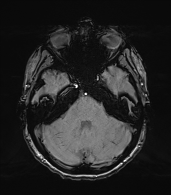 Normal brain MRI (TLE protocol) (Radiopaedia 40748-43405 Axial SWI 24).png
