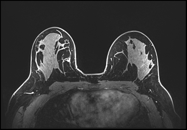 Normal breast MRI - dense breasts (Radiopaedia 80454-93850 C 123).jpg