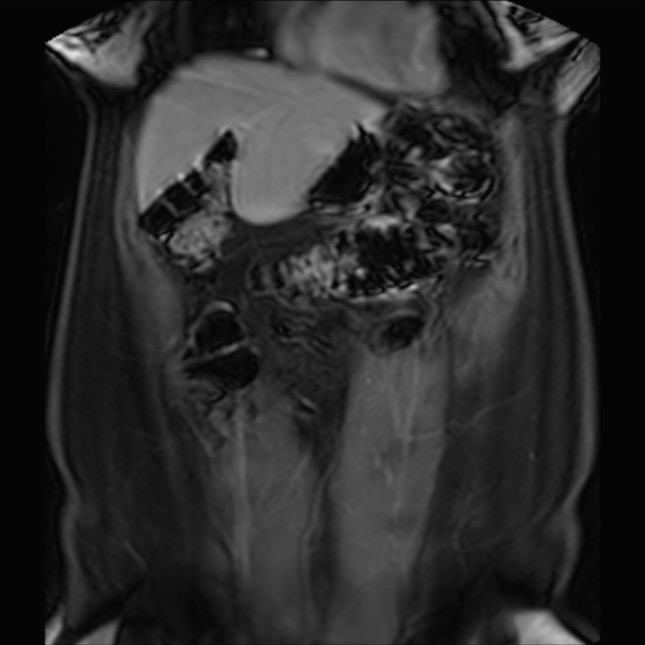 Normal liver MRI with Gadolinium (Radiopaedia 58913-66163 P 22).jpg