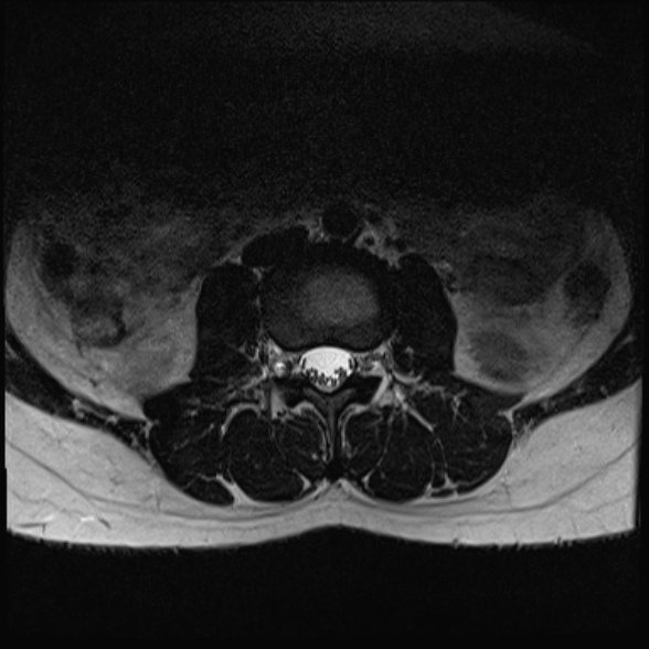 File:Normal lumbar spine MRI- 3 T (Radiopaedia 53280-59250 Axial T2 6).jpg