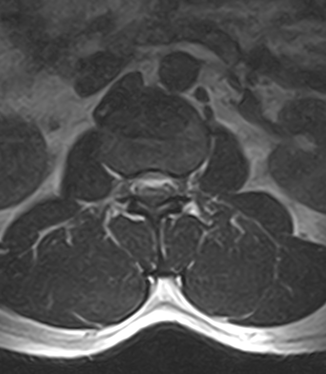 Normal lumbar spine MRI - low-field MRI scanner (Radiopaedia 40976-43699 Axial T2 28).jpg