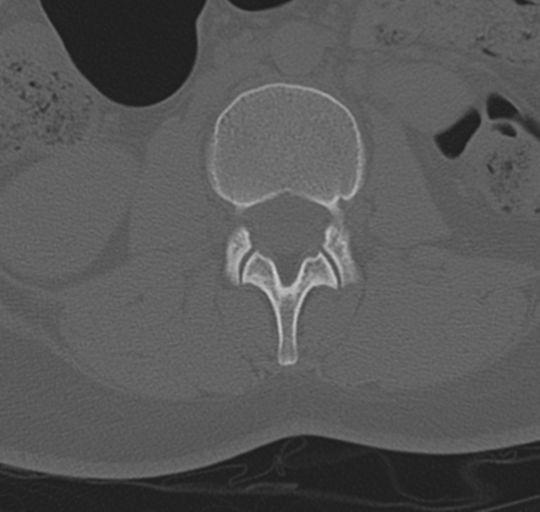 File:Normal lumbosacral CT (Radiopaedia 37923-39867 Axial bone window 48).png