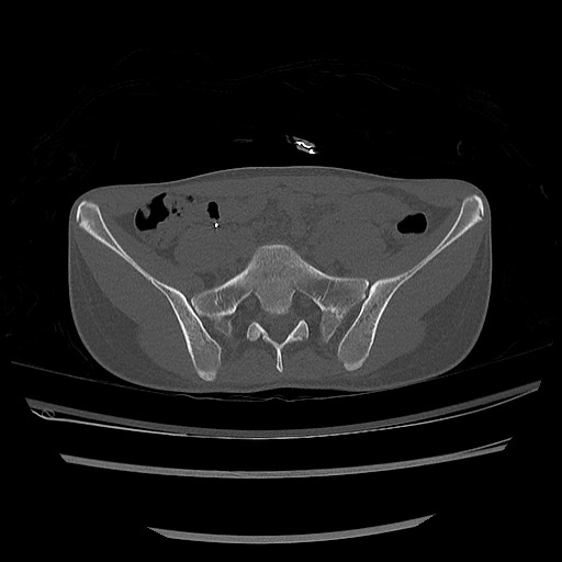 Normal pelvis CT (Radiopaedia 51471-57236 Axial bone window 26).jpg
