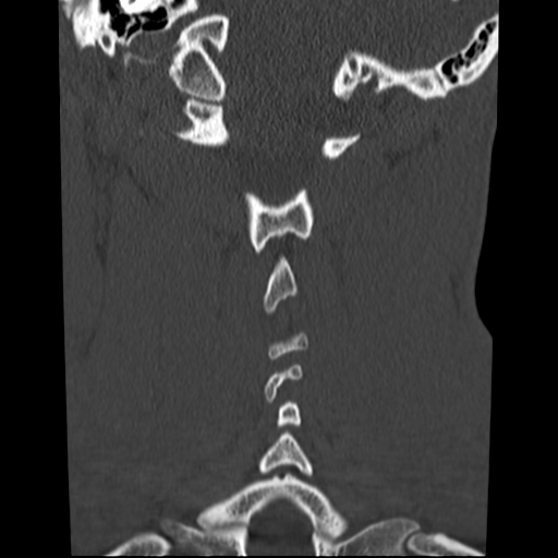 File:Normal trauma cervical spine (Radiopaedia 41017-43760 Coronal bone window 31).png