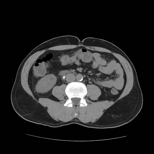 File:Obstructed kidney with perinephric urinoma (Radiopaedia 26889-27067 Axial non-contrast 21).jpg