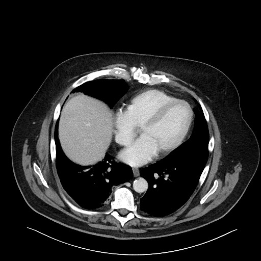 Obstructing sigmoid adenocarcinoma (Radiopaedia 58465-65619 A 13).jpg