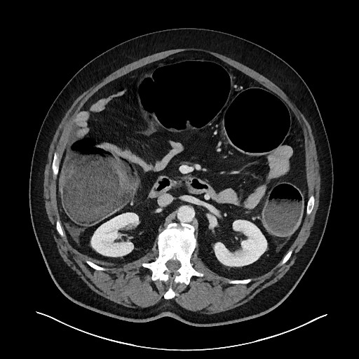 Obstructing sigmoid adenocarcinoma (Radiopaedia 58465-65619 A 66).jpg