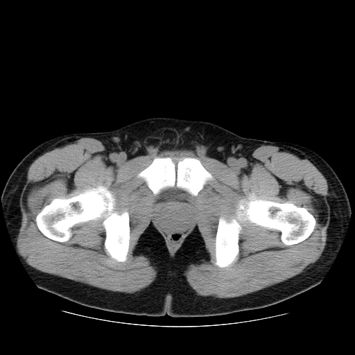 File:Obstructing ureteric calculus (Radiopaedia 18615-18514 Axial non-contrast 57).jpg